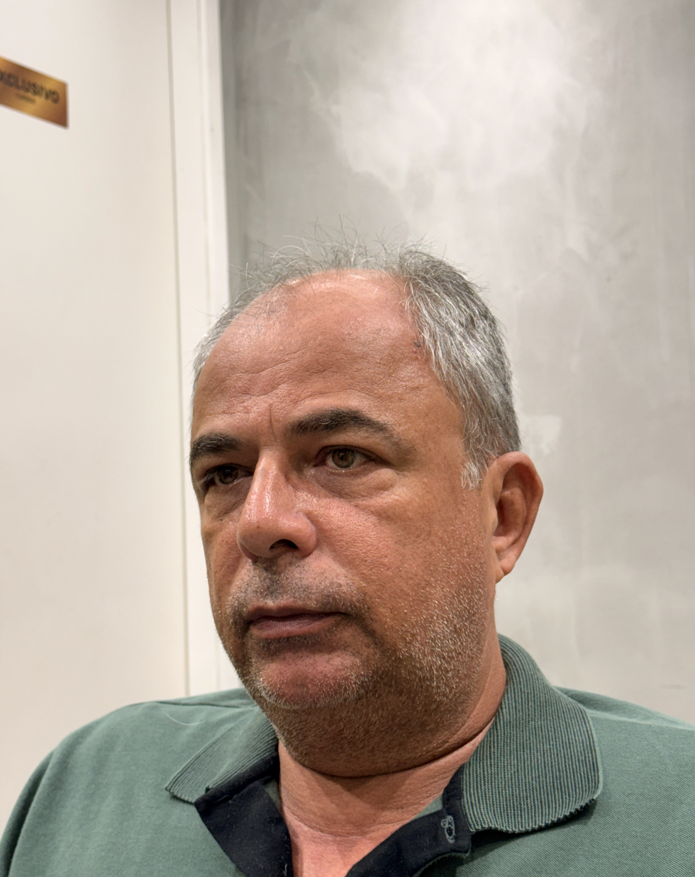 Antes da prótese capilar