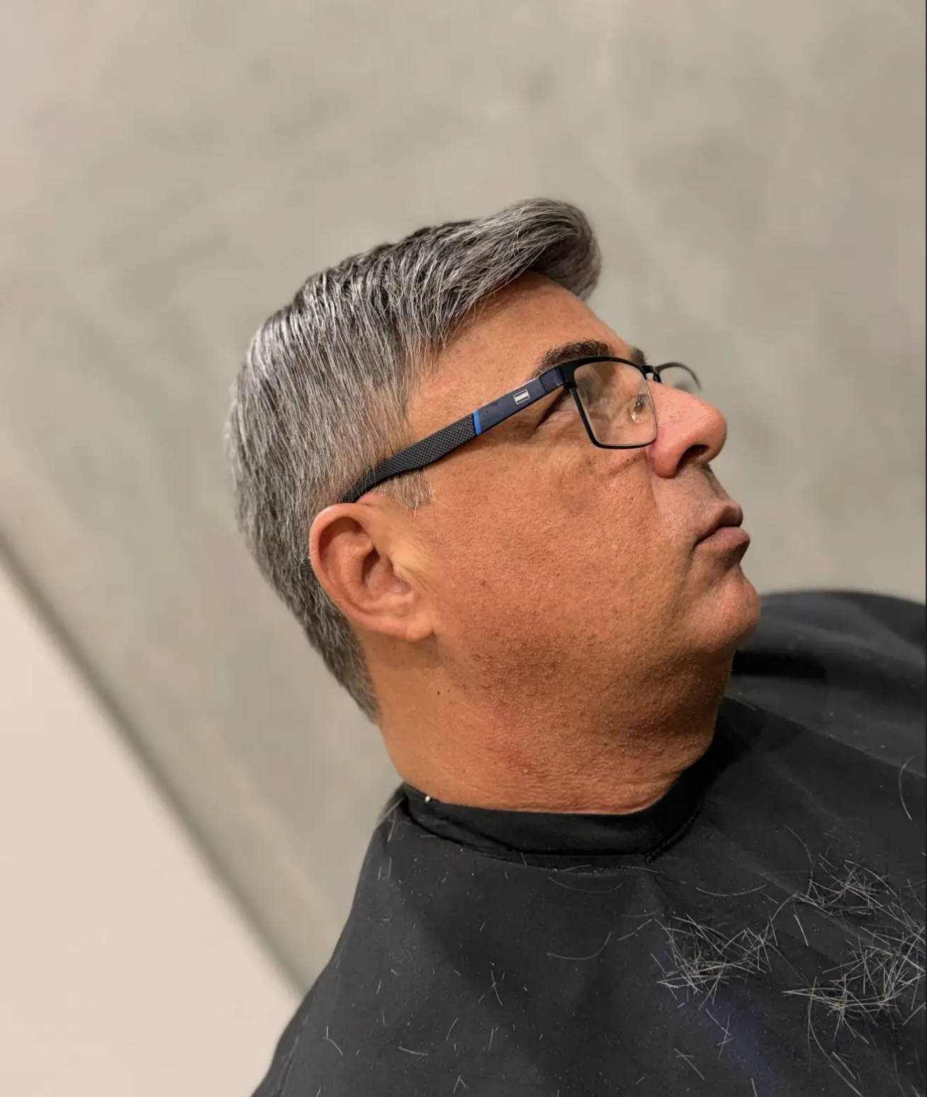 Depois da prótese capilar